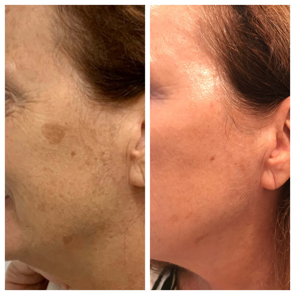 ZO Prescription Pigment Control Program + ZO 3 Step Chemical Peel